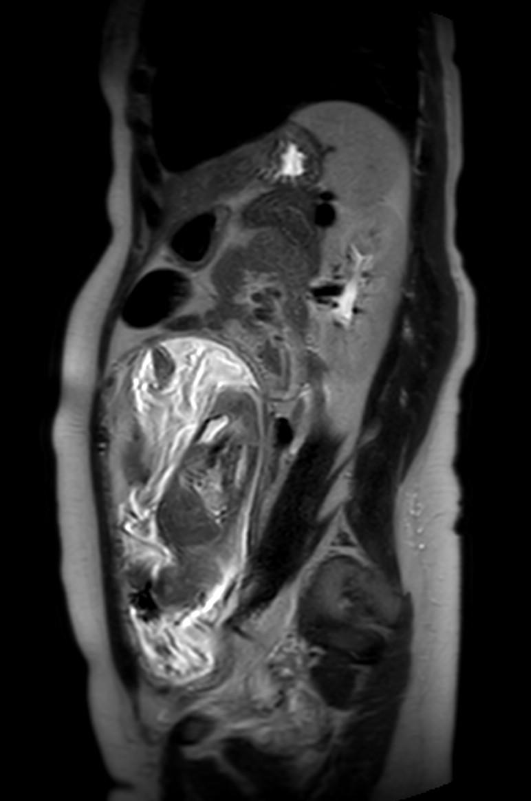 Appendicitis in gravida (MRI) (Radiopaedia 89433-106395 Sagittal T2 24).jpg