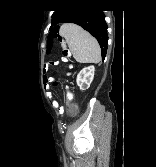 Appendicitis with localized perforation and abscess formation (Radiopaedia 49035-54130 C 14).jpg