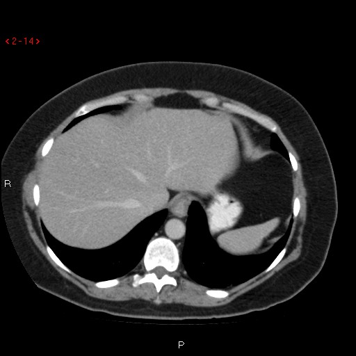 File:Appendicitis with microperforation- promontoric type (Radiopaedia 27268-27442 C 2).jpg