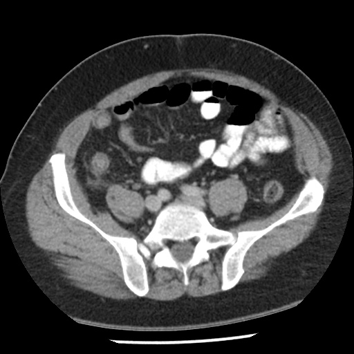 Appendicitis with perforation (Radiopaedia 35790-37342 A 36).jpg
