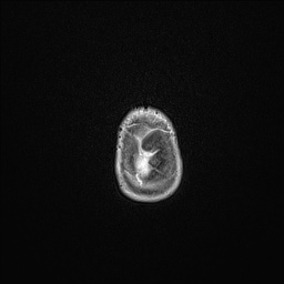 Aqueductal stenosis (Radiopaedia 73974-84802 Axial T1 C+ 140).jpg