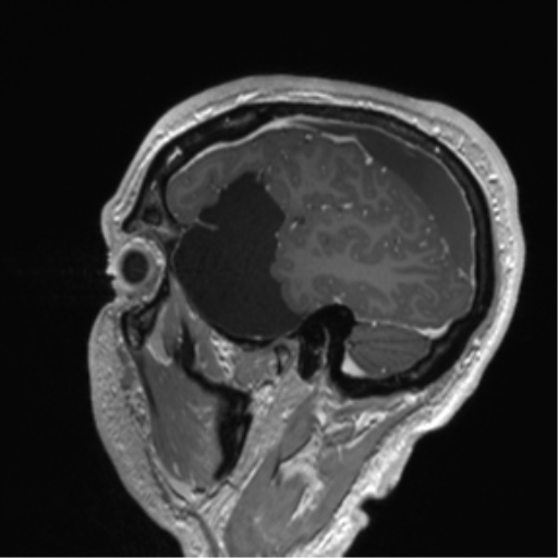 Arachnoid cyst with subdural hematoma (Radiopaedia 85892-101743 Sagittal T1 C+ 23).png