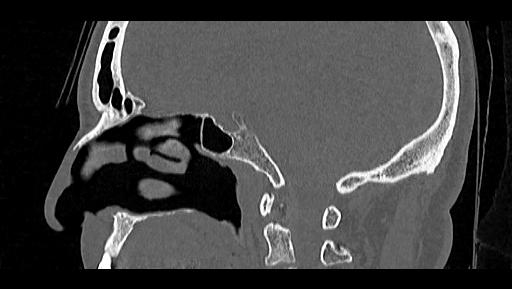 File:Arcuate foramen (Radiopaedia 89833-106944 Sagittal bone window 47).jpg