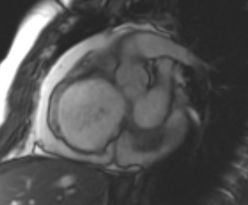 Arrhythmogenic right ventricular cardiomyopathy (Radiopaedia 69431-79307 Short axis cine 201).jpg