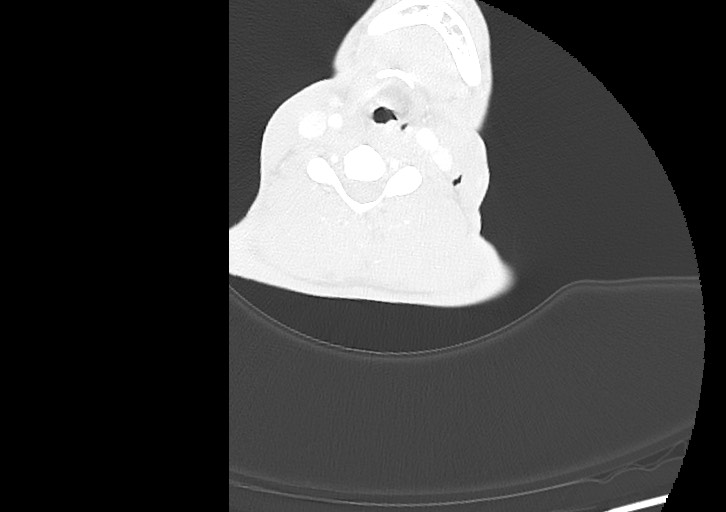 Arrow injury in the neck (Radiopaedia 75268-86390 Axial lung window 193).jpg