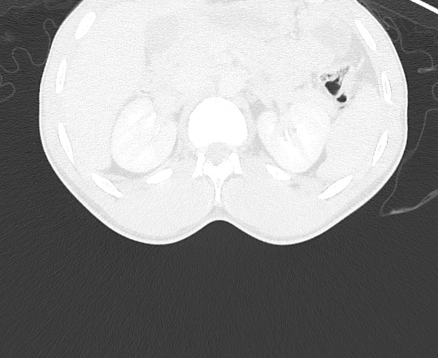Arrow injury to the chest (Radiopaedia 75223-86321 Axial lung window 119).jpg