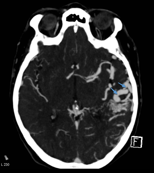 File:Arteriovenous malformation - cerebral (Radiopaedia 8172-14683 Figure 2 1).png