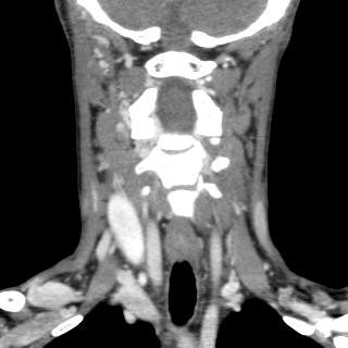 File:Arteriovenous malformation of the neck (Radiopaedia 53935-60062 D 7).jpg