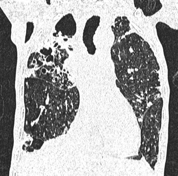 Aspergilloma- with Monod sign (Radiopaedia 44737-48532 Coronal lung window 221).jpg