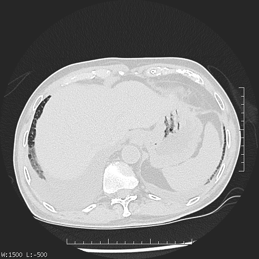 Aspergilloma (Radiopaedia 75184-86270 Axial lung window 48).jpg