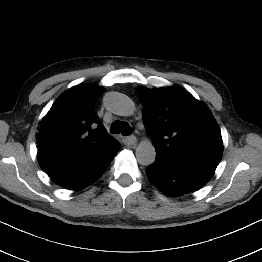 Aspergilloma on background pulmonary fibrosis (Radiopaedia 60942-68757 Axial non-contrast 21).jpg