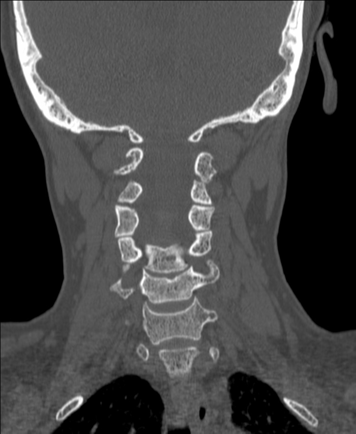Atlanto-occipital assimilation with basilar invagination (Radiopaedia 70122-80188 Coronal bone window 125).jpg