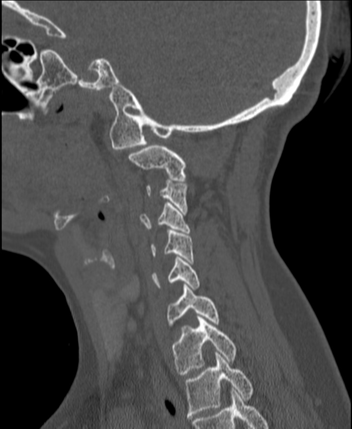 Atlanto-occipital assimilation with basilar invagination (Radiopaedia 70122-80188 Sagittal bone window 107).jpg