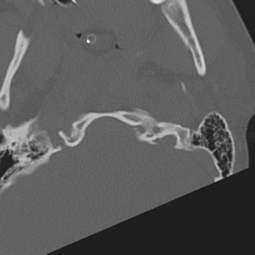 File:Atlanto-occipital dissociation (Radiopaedia 33848-35013 Axial bone window 3).png