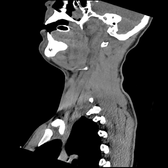 File:Atlanto-occipital dissociation (Traynelis type 1), C2 teardrop fracture, C6-7 facet joint dislocation (Radiopaedia 87655-104061 D 29).jpg