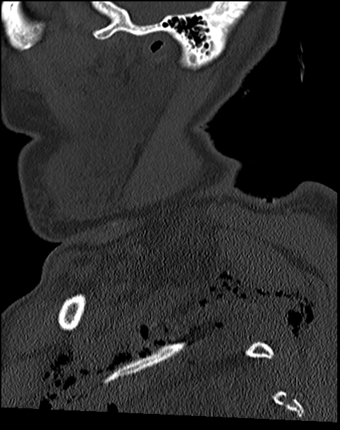 Atlanto-occipital dissociation - Traynelis type 1 (Radiopaedia 87570-103948 Sagittal bone window 15).jpg