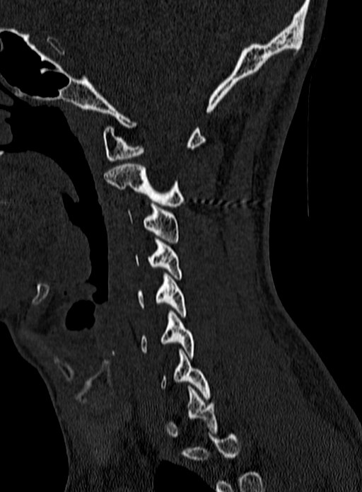 Atlantoaxial subluxation (Radiopaedia 44681-48450 Sagittal bone window 28).jpg