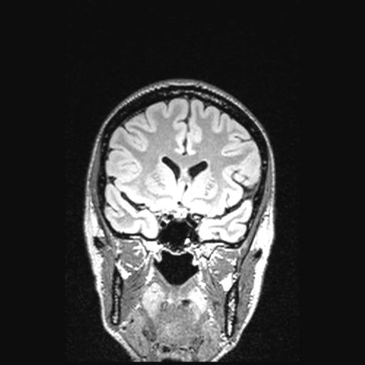 Atretic encephalocoele with inferior vermis hypoplasia (Radiopaedia 30443-31108 Coronal FLAIR 122).jpg