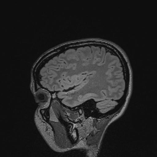 Atretic encephalocoele with inferior vermis hypoplasia (Radiopaedia 30443-31108 Sagittal FLAIR 44).jpg