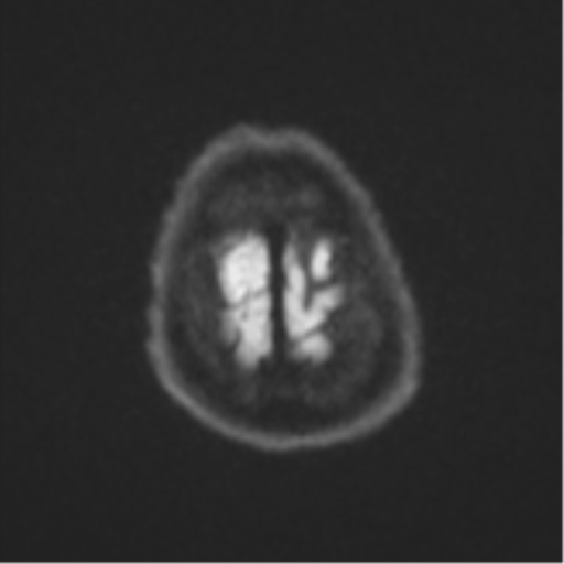 File:Atypical meningioma (WHO Grade II) (Radiopaedia 54742-60981 Axial DWI 54).png