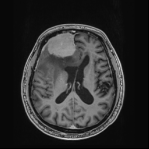 File:Atypical meningioma (WHO grade II) with brain invasion (Radiopaedia 57767-64729 Axial T1 C+ 28).png