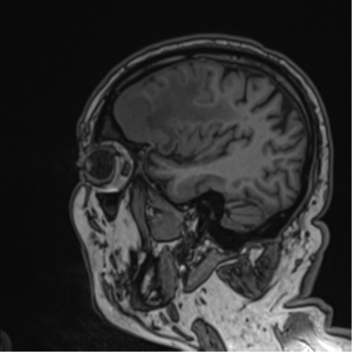 File:Atypical meningioma (WHO grade II) with brain invasion (Radiopaedia 57767-64729 Sagittal T1 50).png