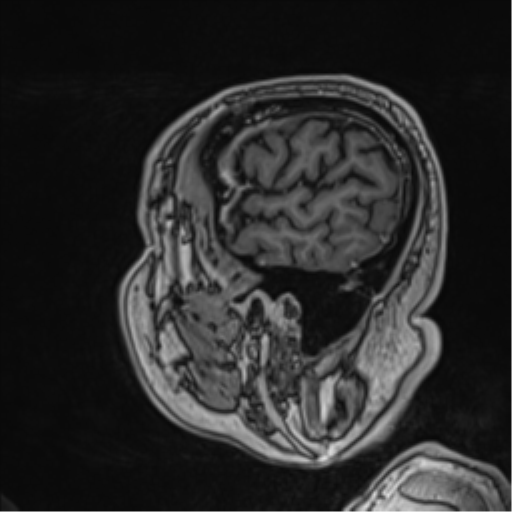 Atypical meningioma (WHO grade II) with brain invasion (Radiopaedia 57767-64729 Sagittal T1 C+ 16).png