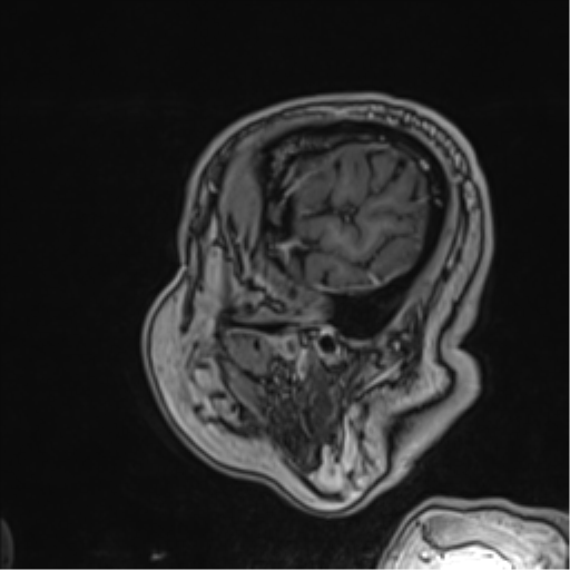 Atypical meningioma (WHO grade II) with brain invasion (Radiopaedia 57767-64729 Sagittal T1 C+ 58).png
