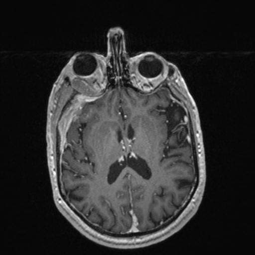 Atypical meningioma (grade II) - en plaque (Radiopaedia 29633-30147 Axial T1 C+ 107).jpg