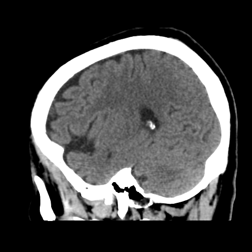 Atypical meningioma with skull invasion (Radiopaedia 34357-35649 E 39).png