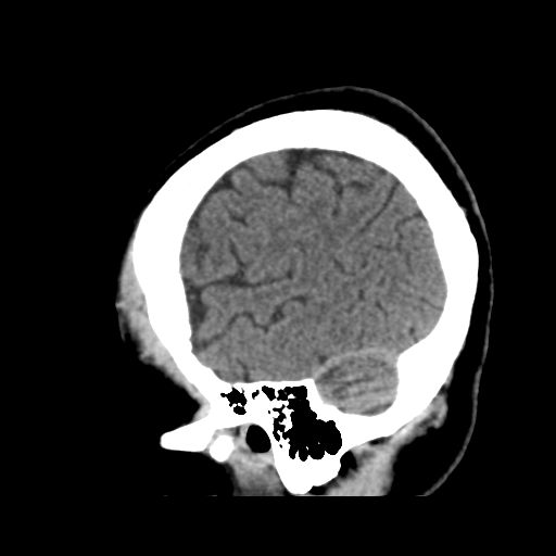 File:Atypical meningioma with skull invasion (Radiopaedia 34357-35649 E 46).png