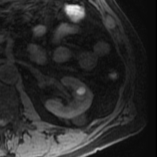 File:Atypical renal cyst on MRI (Radiopaedia 17349-17046 Axial T1 fat sat 16).jpg
