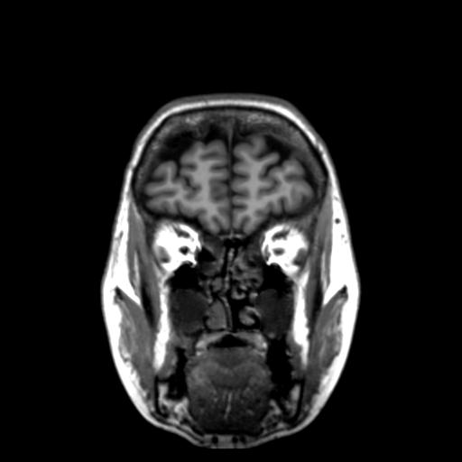 Autoimmune limbic encephalitis (Radiopaedia 30363-31005 Coronal T1 47).jpg