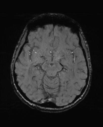 Autoimmune limbic encephalitis (Radiopaedia 30363-31005 SWI - magnitude 32).jpg