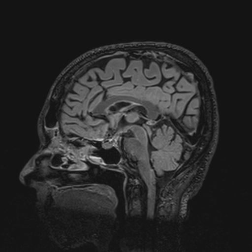 Autoimmune limbic encephalitis (Radiopaedia 30363-31005 Sagittal FLAIR 82).jpg