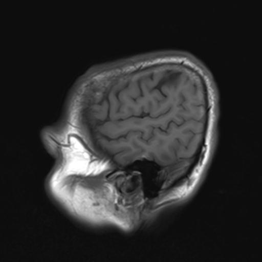 File:Autoimmune limbic encephalitis (Radiopaedia 30363-31005 Sagittal T1 23).jpg