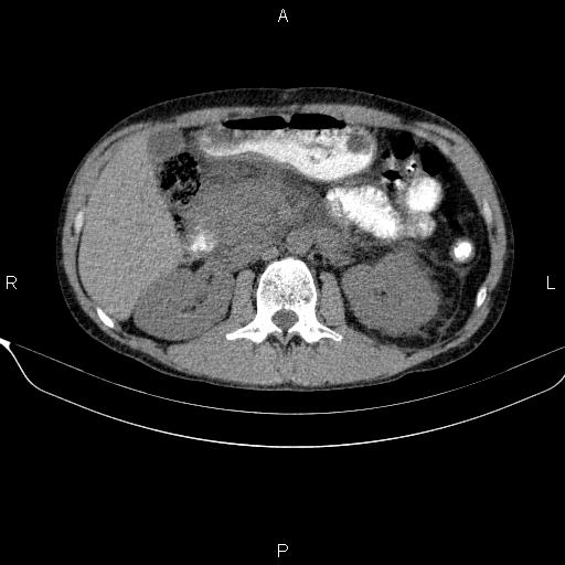 Autoimmune pancreatitis (Radiopaedia 84925-100431 Axial non-contrast 23).jpg