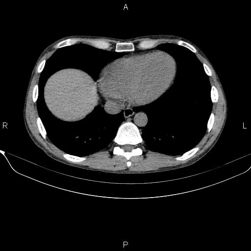 Autoimmune pancreatitis (Radiopaedia 84925-100431 Axial non-contrast 5).jpg