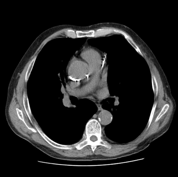 Autosomal dominant polycystic kidney disease (Radiopaedia 27851-28094 Axial non-contrast 28).jpg