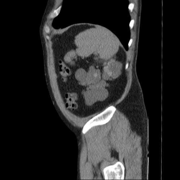 Autosomal dominant polycystic kidney disease (Radiopaedia 36539-38101 D 72).jpg