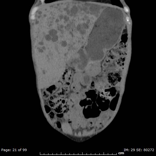 File:Autosomal dominant polycystic kidney disease (Radiopaedia 44122-47684 Coronal 23).jpg