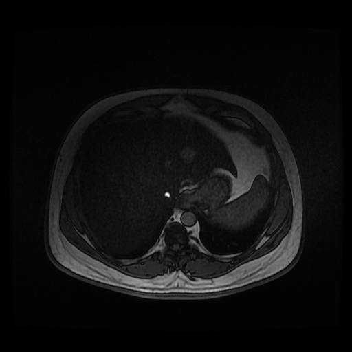 Autosomal dominant polycystic kidney disease (Radiopaedia 50259-55611 Axial 2D Dual Echo 19).jpg
