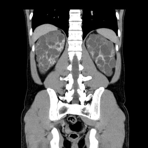 Autosomal dominant polycystic kidney disease (Radiopaedia 66349-75582 A 68).jpg