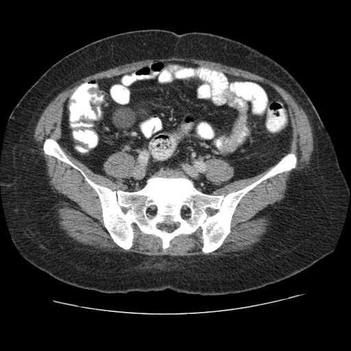 Autosomal dominant polycystic kidney disease with hepatic involvement (Radiopaedia 32693-33662 B 58).jpg