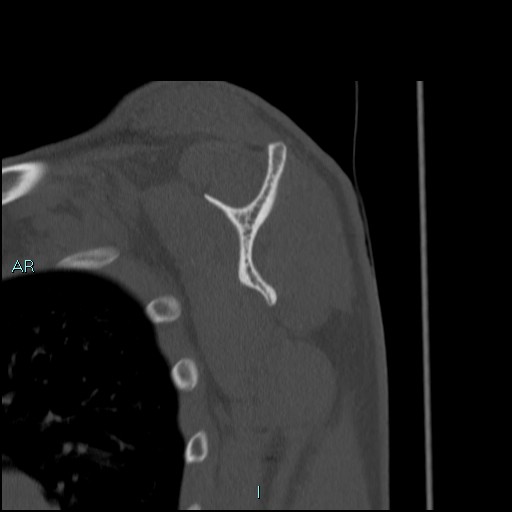 Avascular necrosis after fracture dislocations of the proximal humerus (Radiopaedia 88078-104653 Sagittal bone window 48).jpg
