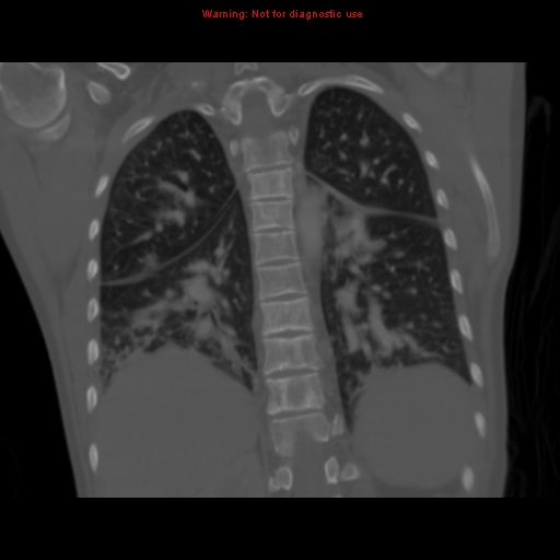 Avascular necrosis in sickle cell disease (Radiopaedia 17448-17152 Coronal bone window 90).jpg