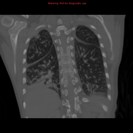Avascular necrosis in sickle cell disease (Radiopaedia 17448-17152 Coronal bone window 97).jpg