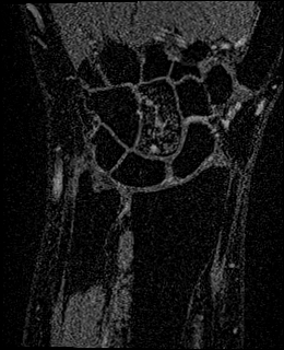 Avascular necrosis of the capitate (Radiopaedia 88317-104948 Coronal T1 vibe 38).jpg