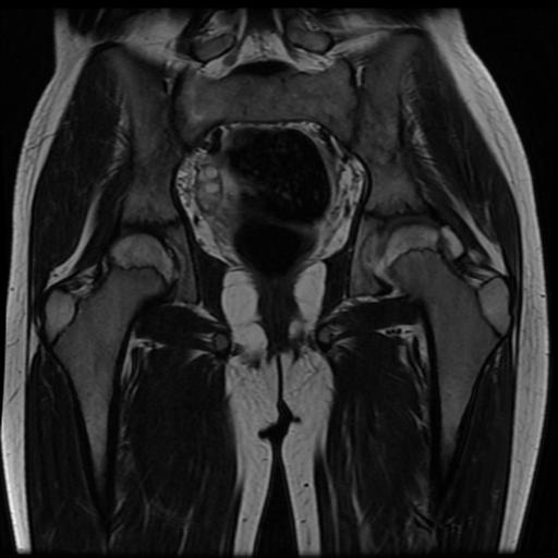 File:Avascular necrosis of the hip (Radiopaedia 29563-30067 Coronal T2 10).jpg
