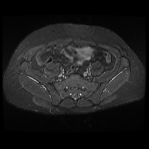 File:Avascular necrosis of the hip (Radiopaedia 61503-69465 Axial STIR 2).jpg